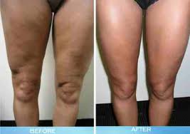 Cellulite Treatments Review