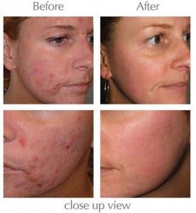 Exposed Skin Care Acne Treatment before after photos