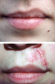 Scar Removal Creams Review