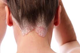 Eczema and Psoriasis Treatments Review