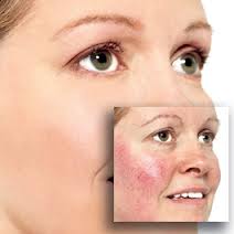 Rosacea Treatment Creams Review