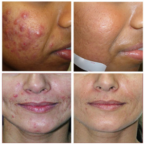 Acne treatment creams