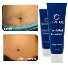 Revitol Stretch-Mark Solution Review