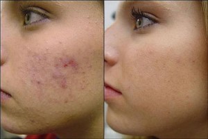 Acne Scars Treatment Review