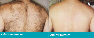 The Great Overall Effectiveness of Revitol Hair Removal Products