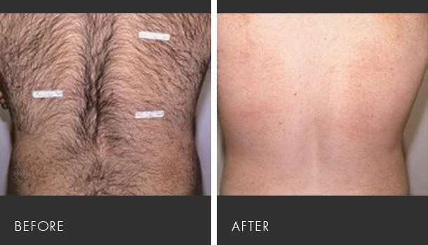 Revitol Body Hair Removal Lotion Reviews & Apparent Scams