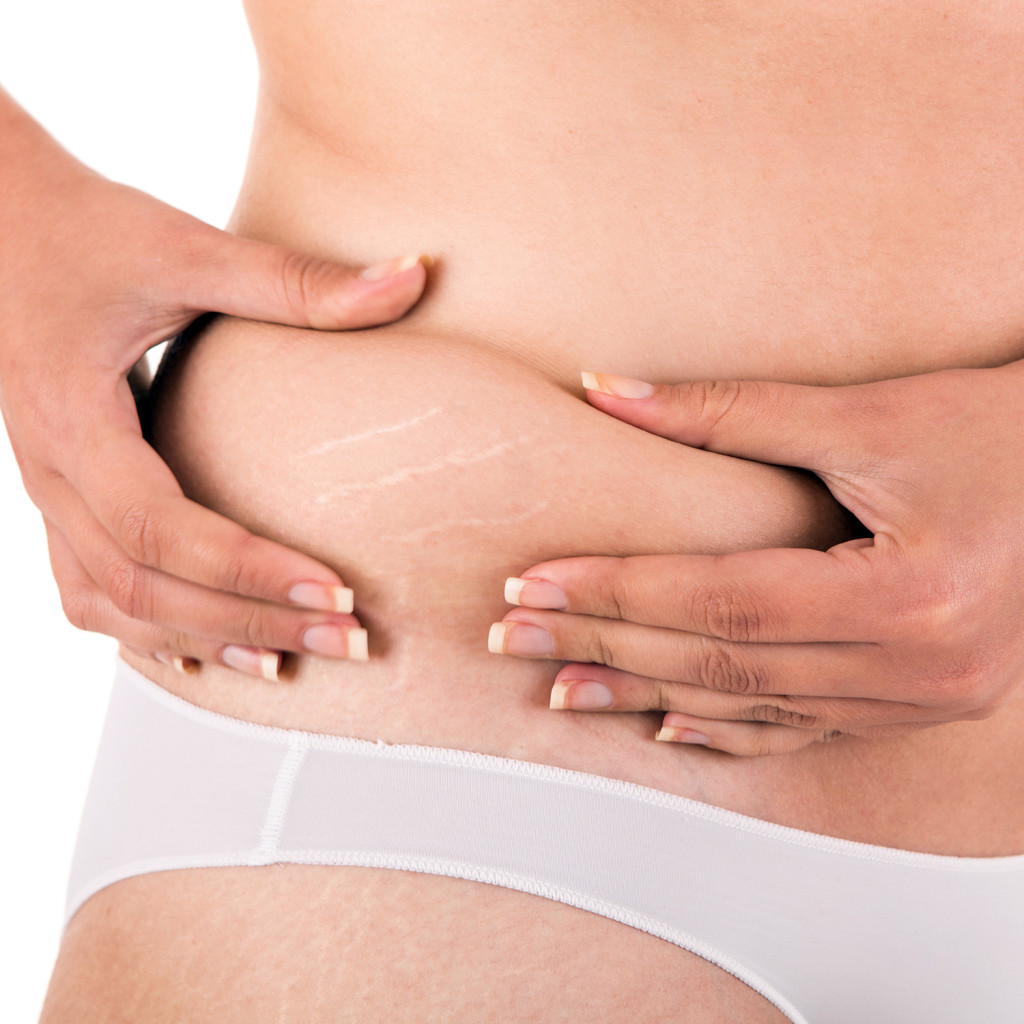 How to Treat Stretch Marks - Revitol